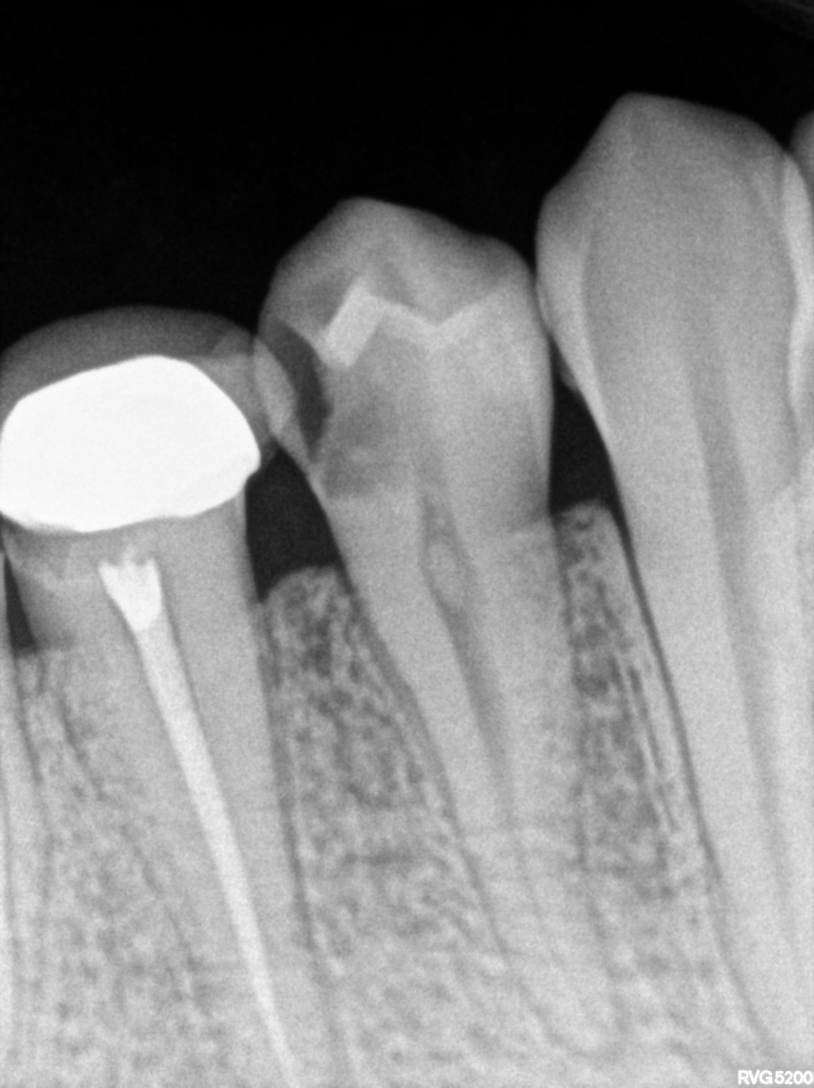 Dental X-ray